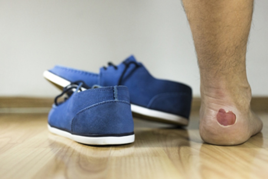 Do You Pop Blood Blisters On Foot Cheap Sale | emergencydentistry.com