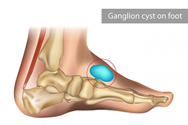 what-is-a-ganglion-cyst